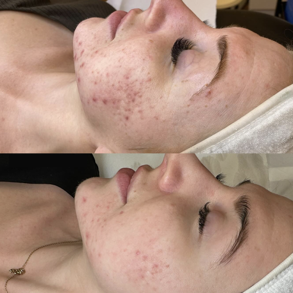 Acne Control Program