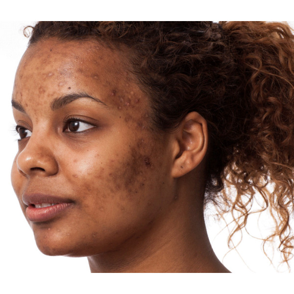 30/10 - Masterclass: All About Hyperpigmentation