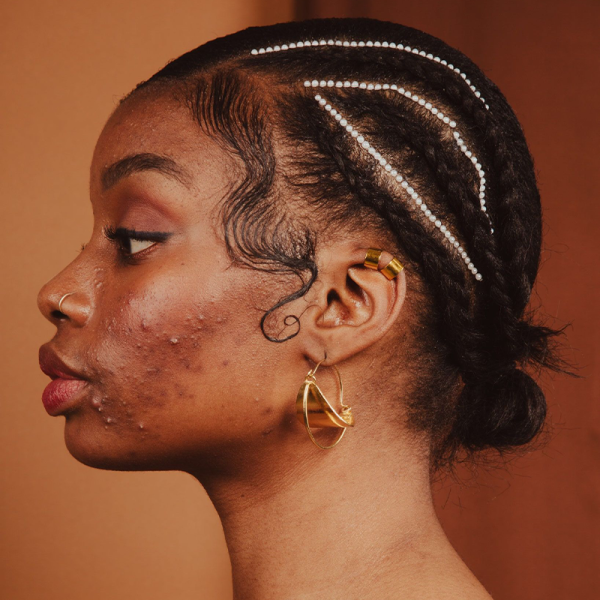 In-person training : Peelings and hyperpigmentation