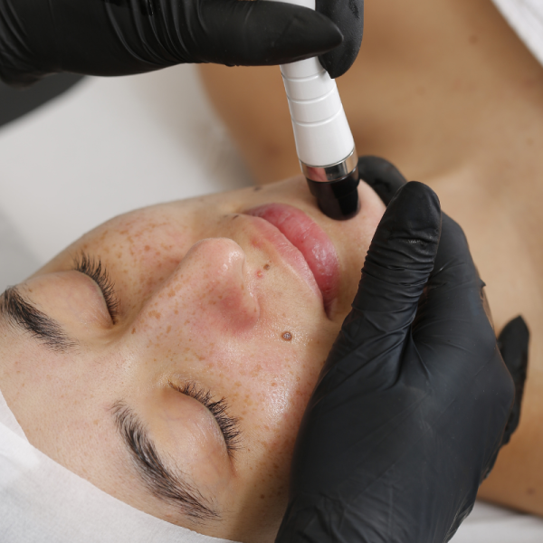 Formation en présentiel: Hyperpigmentations et peelings
