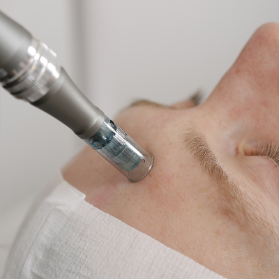 Microneedling