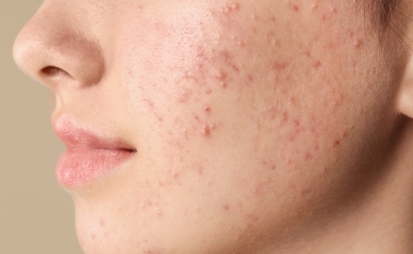 How to determine if your acne is hormonal or bacterial?