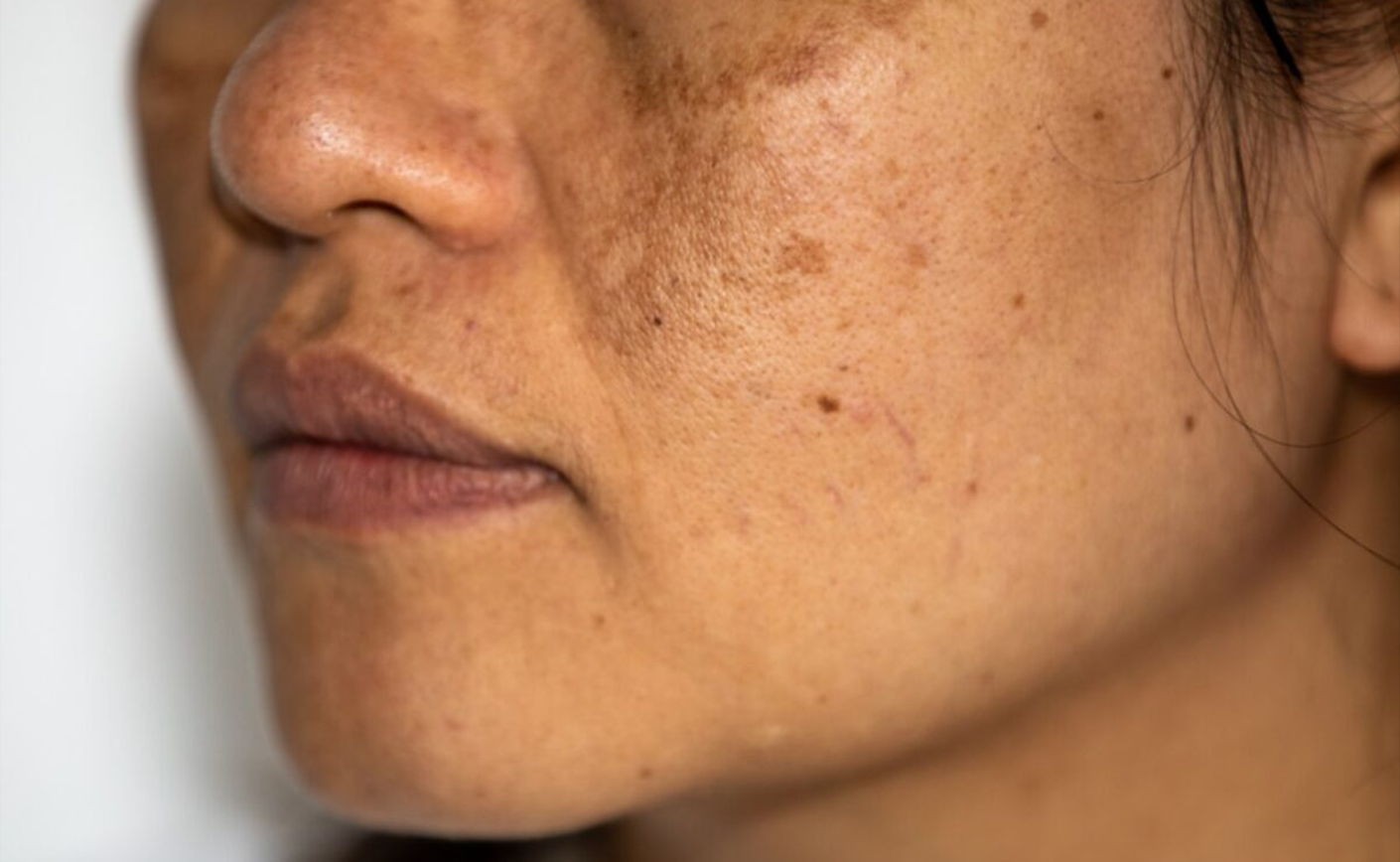 Hyperpigmentation: Causes, Types, and Treatments